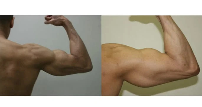 Advanced-Surgical-BodybuildingA®-on-the-right-arm