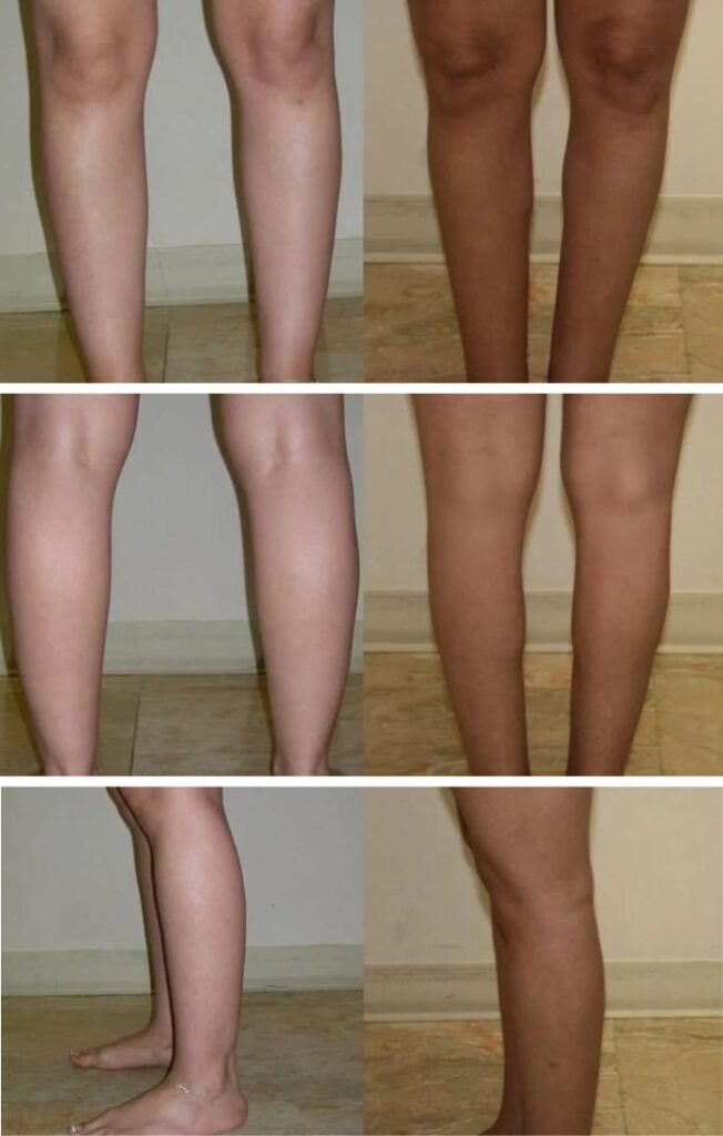 Cankles-before-and-after