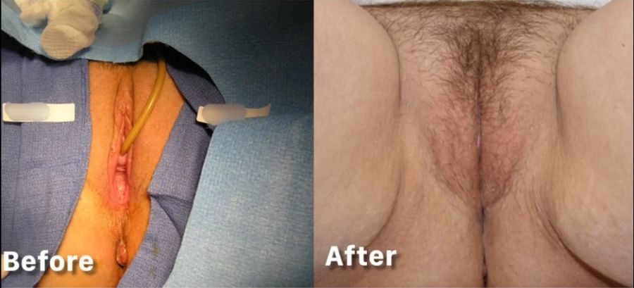 Laser Vaginal Rejuvenation® (LVR®)