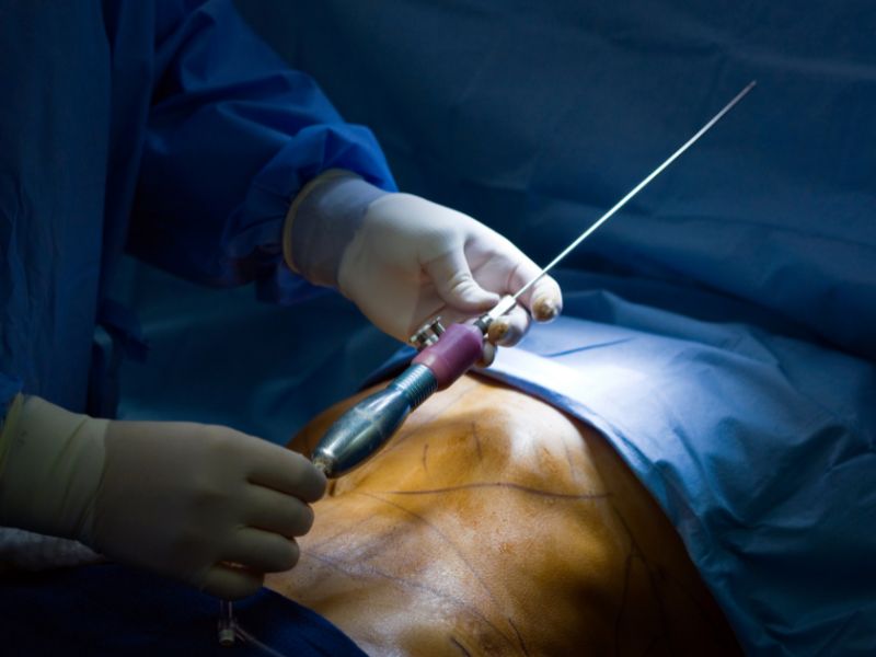 VASER-assisted Liposuction Vs. Traditional Liposuction