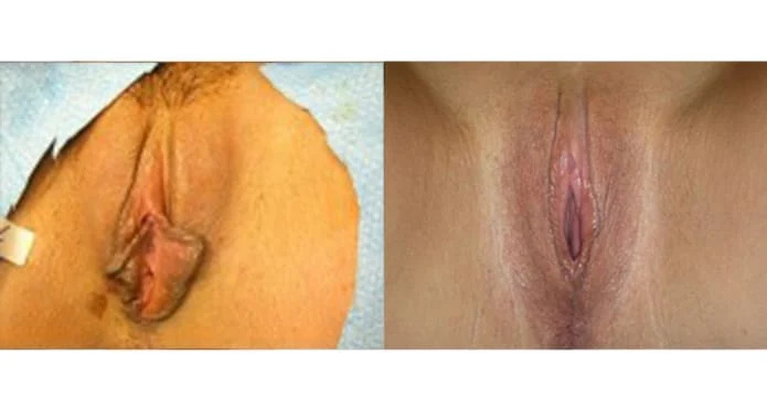 Result-of-Dr.-Matlocks-labiaplasty-procedure