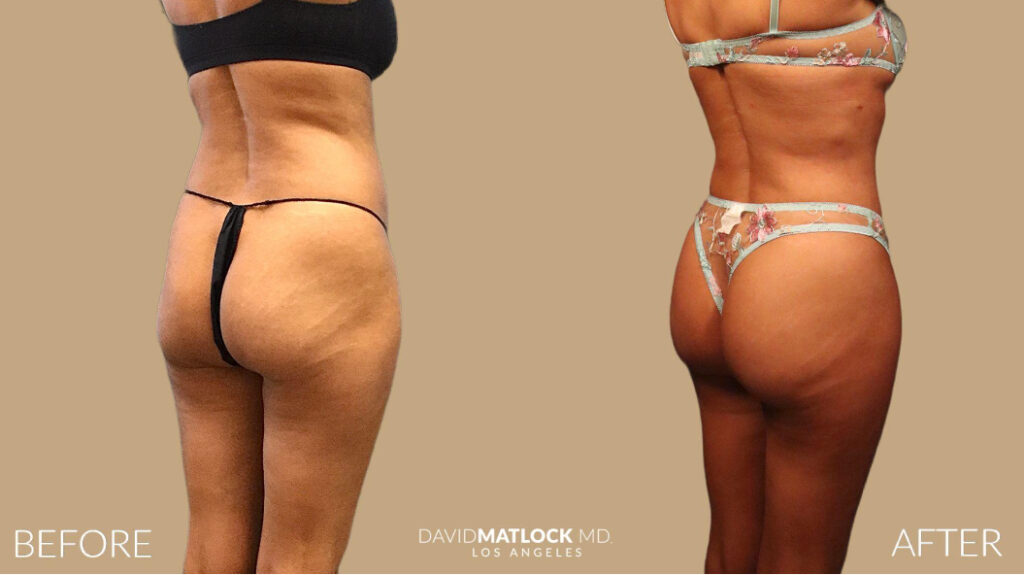 Butt Enhancing Procedures - Dr. Matlock