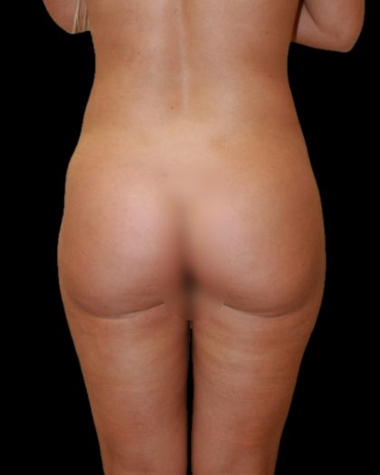 Brazilian Butt Lift Before & After Patient #2701