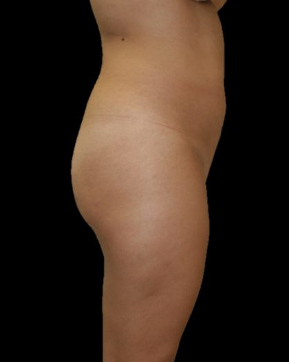 Brazilian Butt Lift Before & After Patient #2702