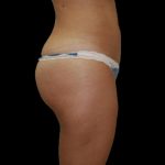 Brazilian Butt Lift Before & After Patient #2702