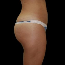 Brazilian Butt Lift Before & After Patient #2702