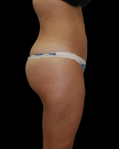 Brazilian Butt Lift Before & After Patient #2702