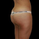 Brazilian Butt Lift Before & After Patient #2702