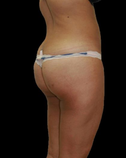 Brazilian Butt Lift Before & After Patient #2702