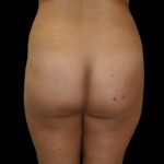 Brazilian Butt Lift Before & After Patient #2702