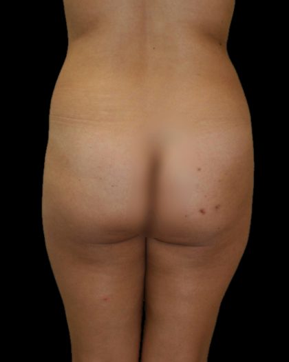 Brazilian Butt Lift Before & After Patient #2702