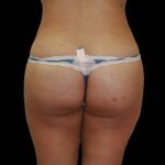 Brazilian Butt Lift Before & After Patient #2702