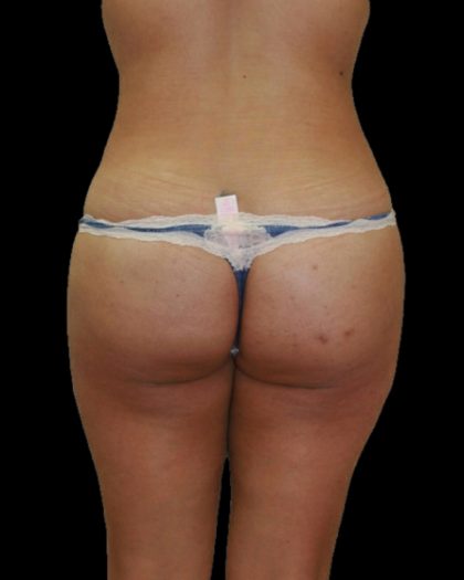 Brazilian Butt Lift Before & After Patient #2702