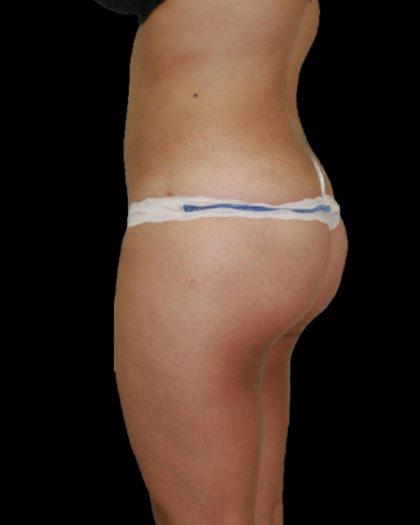 Brazilian Butt Lift Before & After Patient #2702