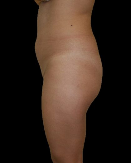 Brazilian Butt Lift Before & After Patient #2702
