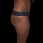 Brazilian Butt Lift Before & After Patient #2703