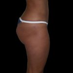 Brazilian Butt Lift Before & After Patient #2703
