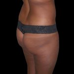 Brazilian Butt Lift Before & After Patient #2703