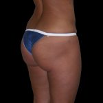 Brazilian Butt Lift Before & After Patient #2703