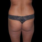 Brazilian Butt Lift Before & After Patient #2703