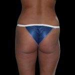 Brazilian Butt Lift Before & After Patient #2703