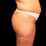 Brazilian Butt Lift Before & After Patient #2692