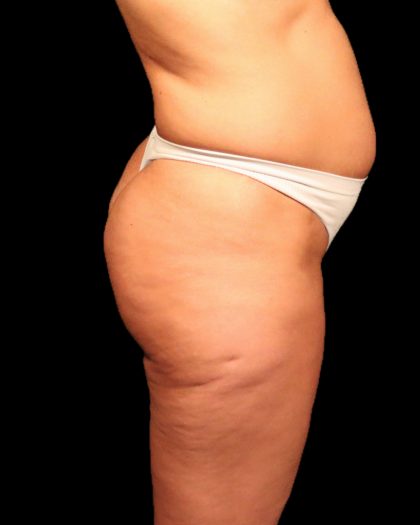 Brazilian Butt Lift Before & After Patient #2692