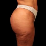 Brazilian Butt Lift Before & After Patient #2692
