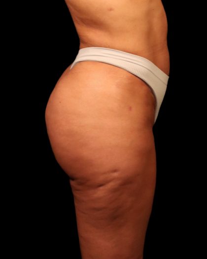 Brazilian Butt Lift Before & After Patient #2692
