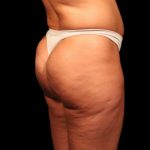Brazilian Butt Lift Before & After Patient #2692