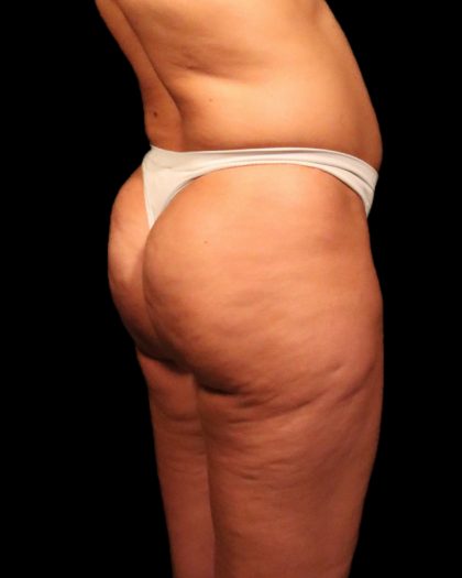 Brazilian Butt Lift Before & After Patient #2692