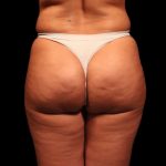 Brazilian Butt Lift Before & After Patient #2692