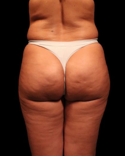 Brazilian Butt Lift Before & After Patient #2692