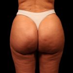 Brazilian Butt Lift Before & After Patient #2692
