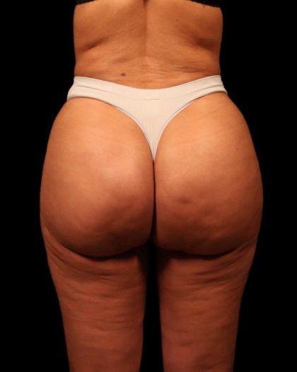 Brazilian Butt Lift Before & After Patient #2692