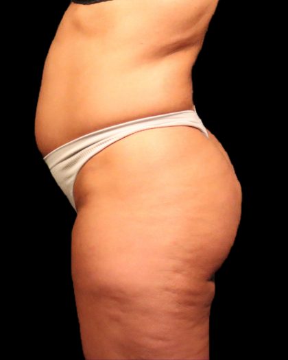 Brazilian Butt Lift Before & After Patient #2692