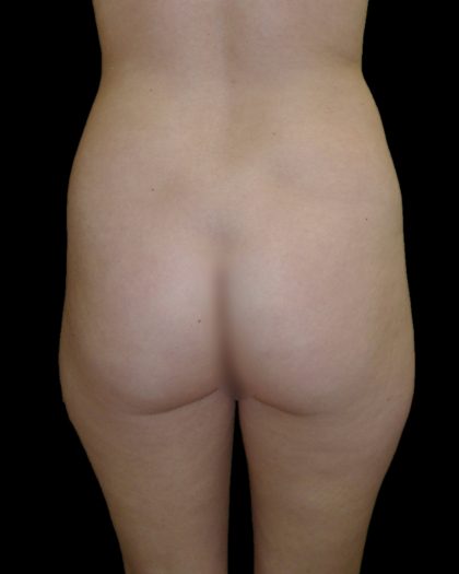 Brazilian Butt Lift Before & After Patient #2693
