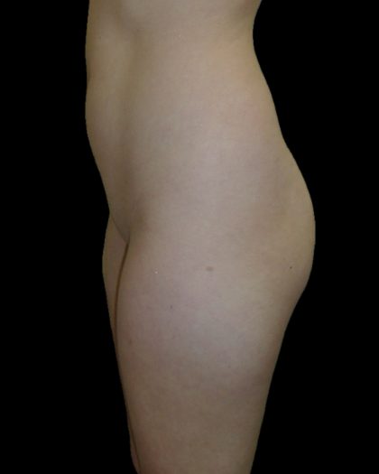 Brazilian Butt Lift Before & After Patient #2693