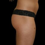 Brazilian Butt Lift Before & After Patient #2694