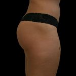 Brazilian Butt Lift Before & After Patient #2694