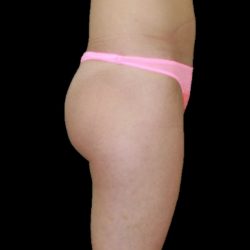 Brazilian Butt Lift Before & After Patient #2695