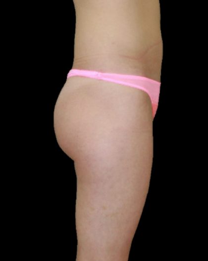Brazilian Butt Lift Before & After Patient #2695