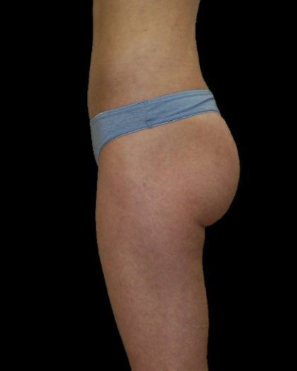 Brazilian Butt Lift Before & After Patient #2695