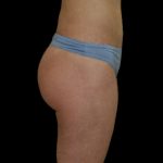 Brazilian Butt Lift Before & After Patient #2695