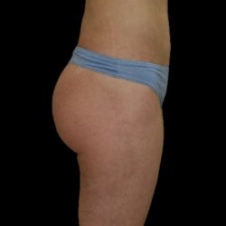 Brazilian Butt Lift Before & After Patient #2695