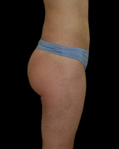 Brazilian Butt Lift Before & After Patient #2695