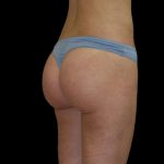 Brazilian Butt Lift Before & After Patient #2695