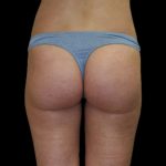 Brazilian Butt Lift Before & After Patient #2695