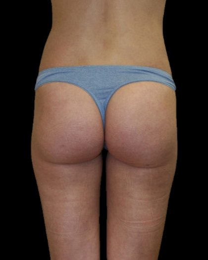 Brazilian Butt Lift Before & After Patient #2695