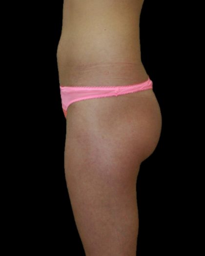 Brazilian Butt Lift Before & After Patient #2695